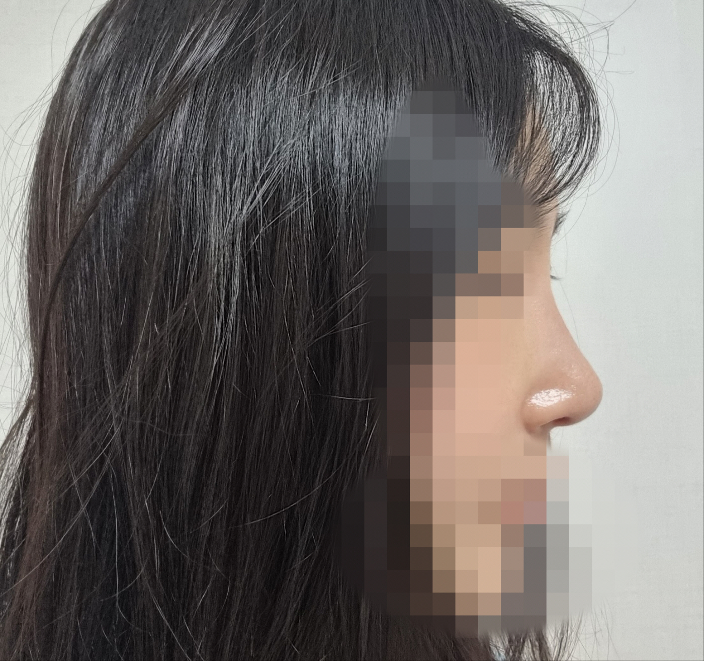 수술 3개월 째 되었어요.