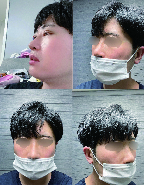 눈,코 수술 후기입니다.