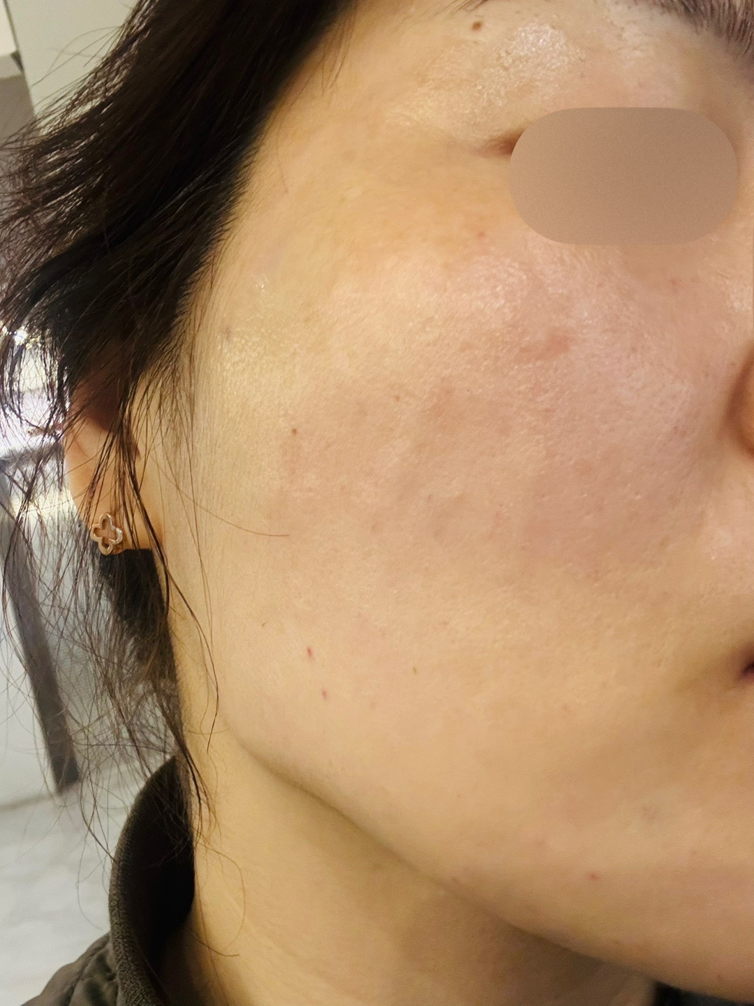 멍도 없고 후처리까지 완벽한 리쥬란, 앞으로 여기서 쭉 할게요~