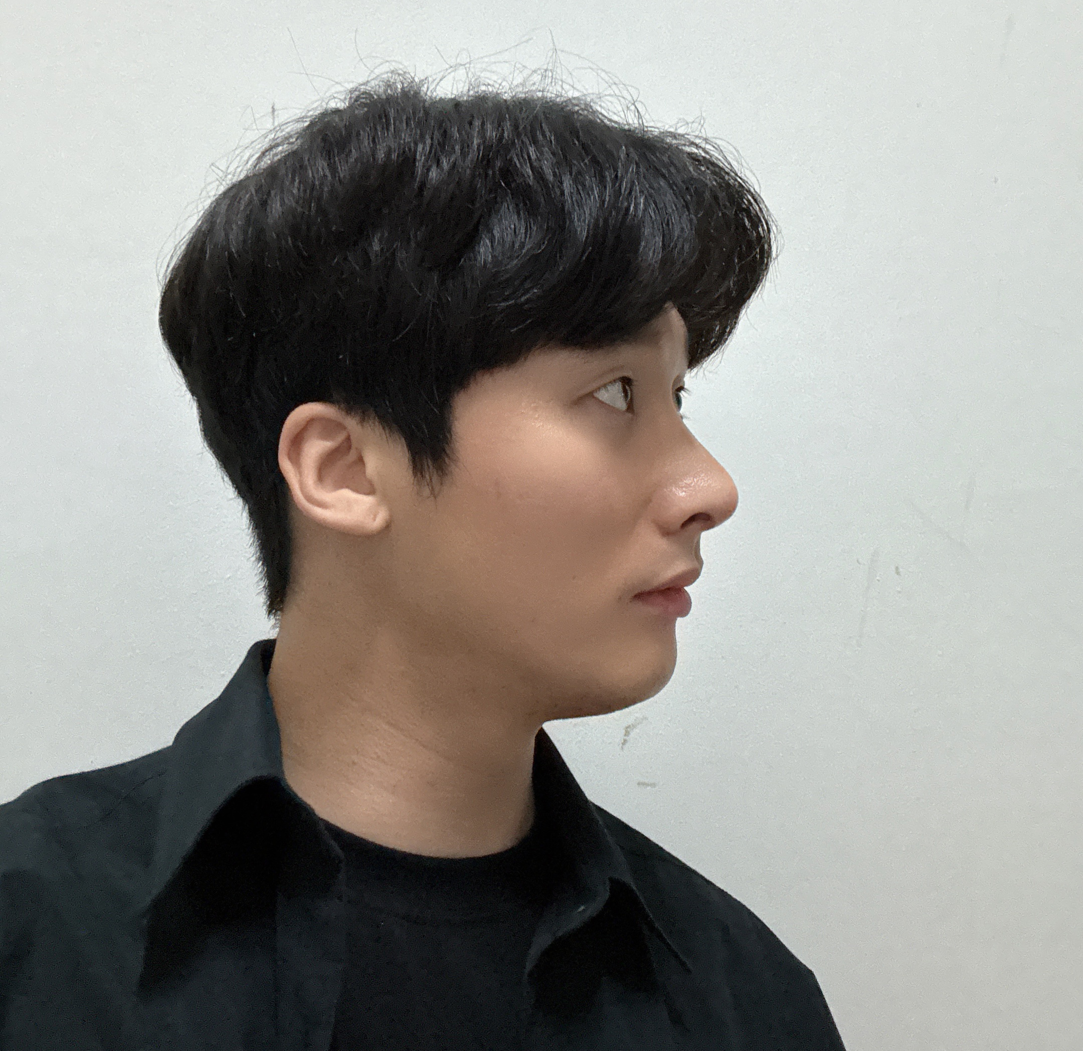 코수술 2주차, 아직 붓기 있지만 결과는 만족하는 중