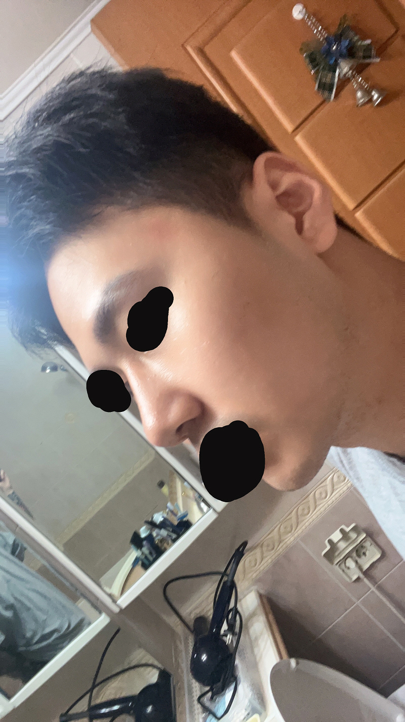 황원장님이 친절하게 상담해주시고 수술결과도 매우 만족스럽습니다.
