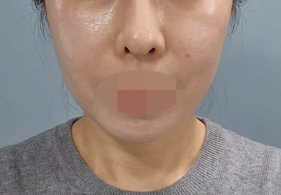 흉터 하나 없이 일상생활 바로 가능! 만족해서 재방문 예정이에요~ㅎㅎ