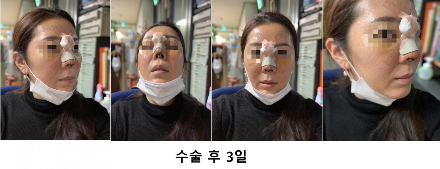 코수술 부목중~