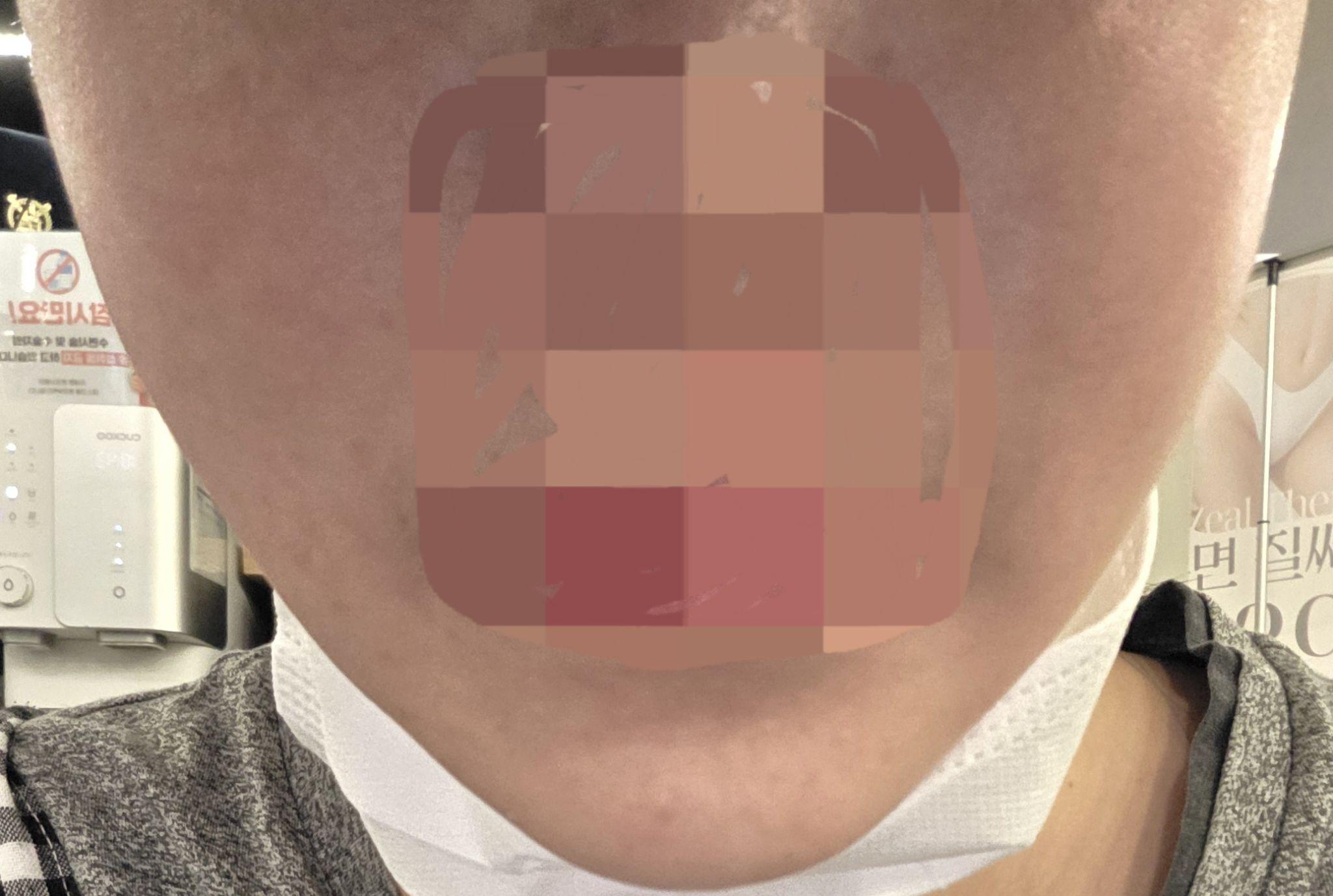 물광 주사 받았는데 통증이랑 붉은기 없어서 놀랐어요 ㅎㅎ