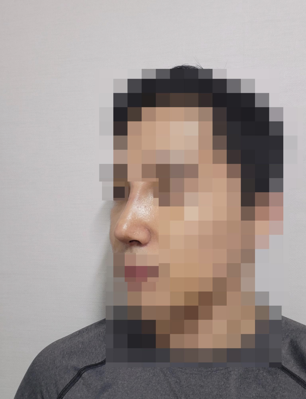 코수술 2주차 입니다.