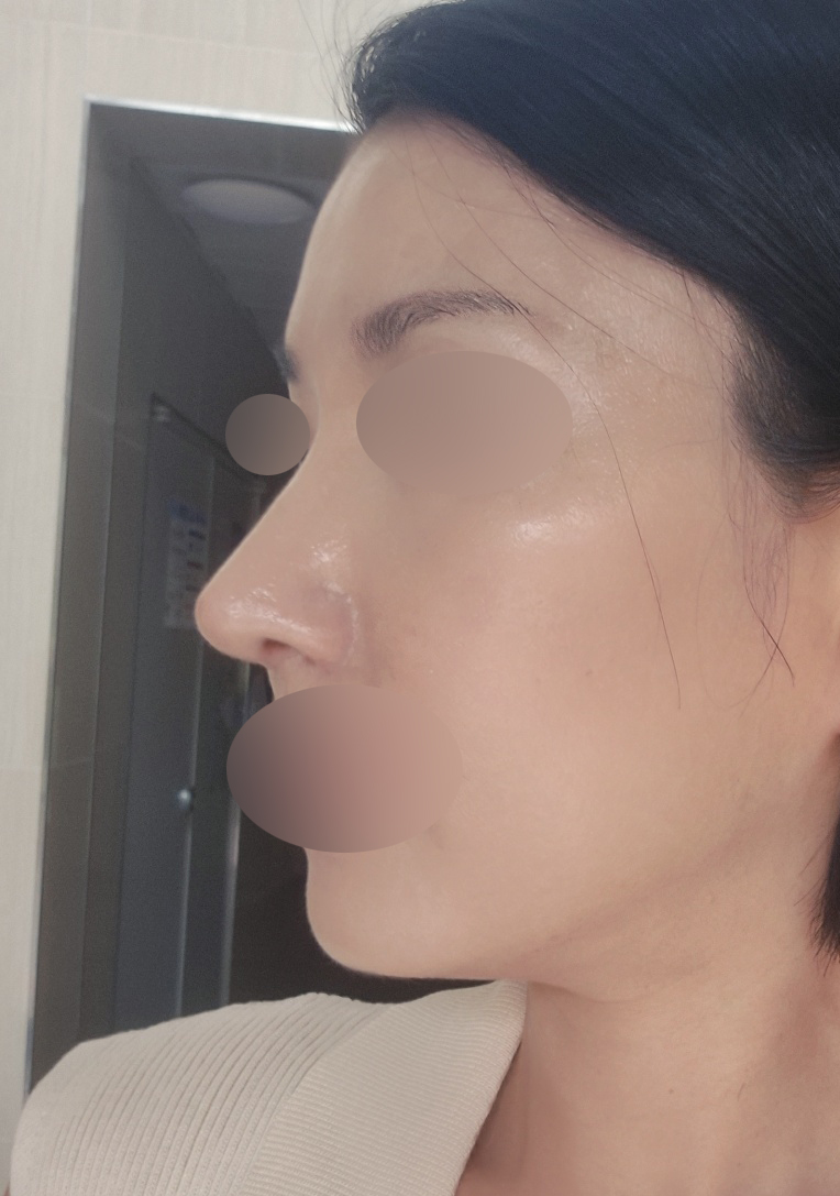 붓기 빠질수록 만족스러운 코수술 3개월차입니다~ㅎ