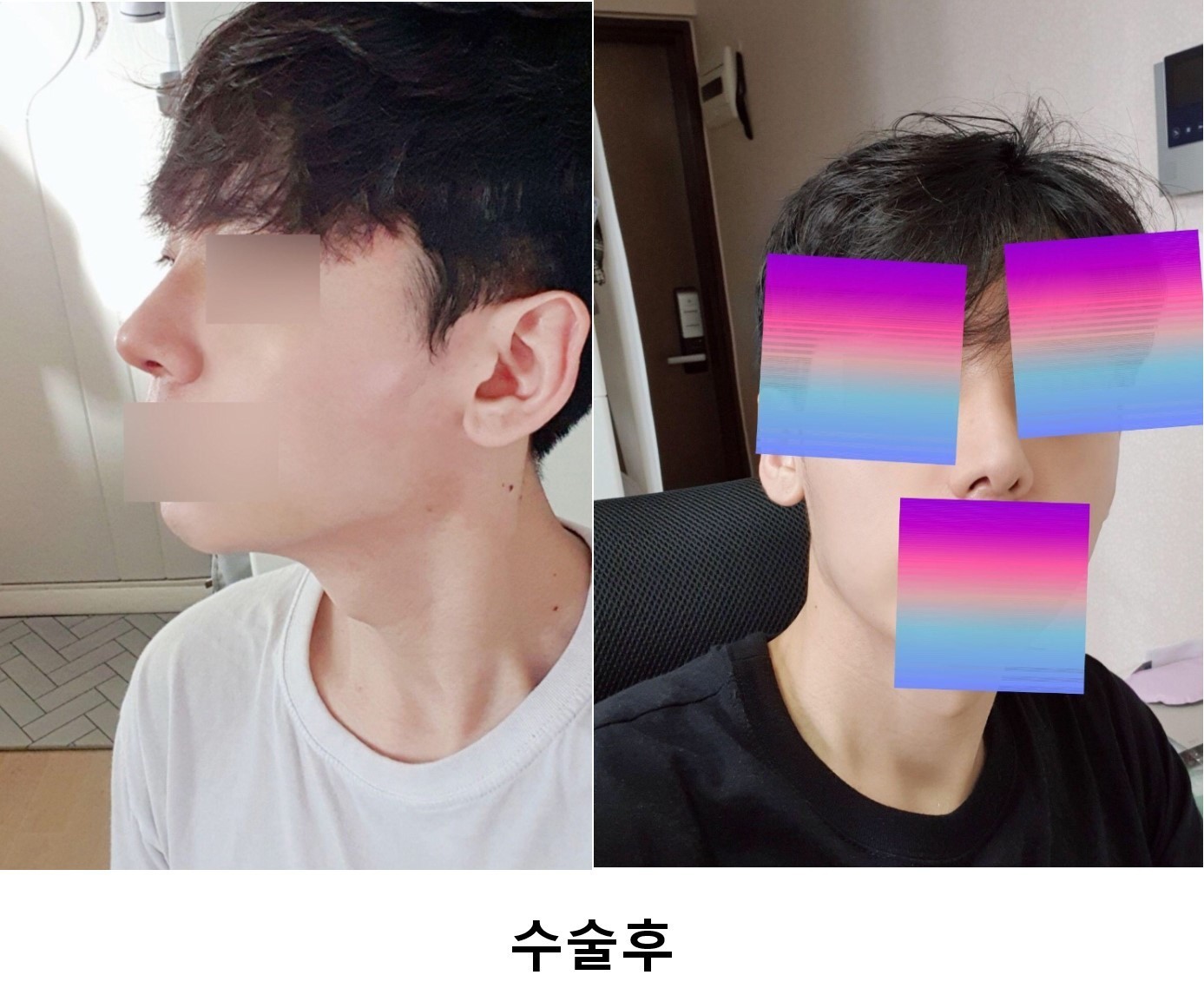 코수술 2주차 후기입니다