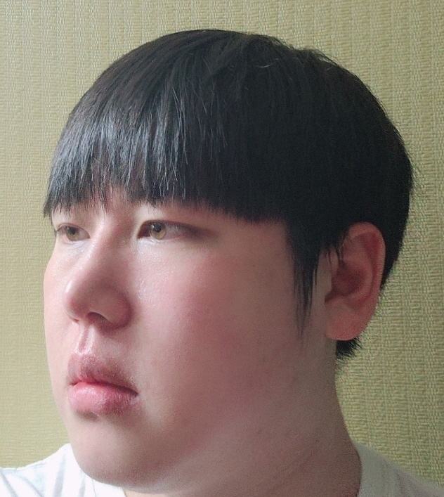 홍태의 짝눈이 심했던 문제가 해결 되고 수술 한달차 지나니까 적응도 확실히 됐어요