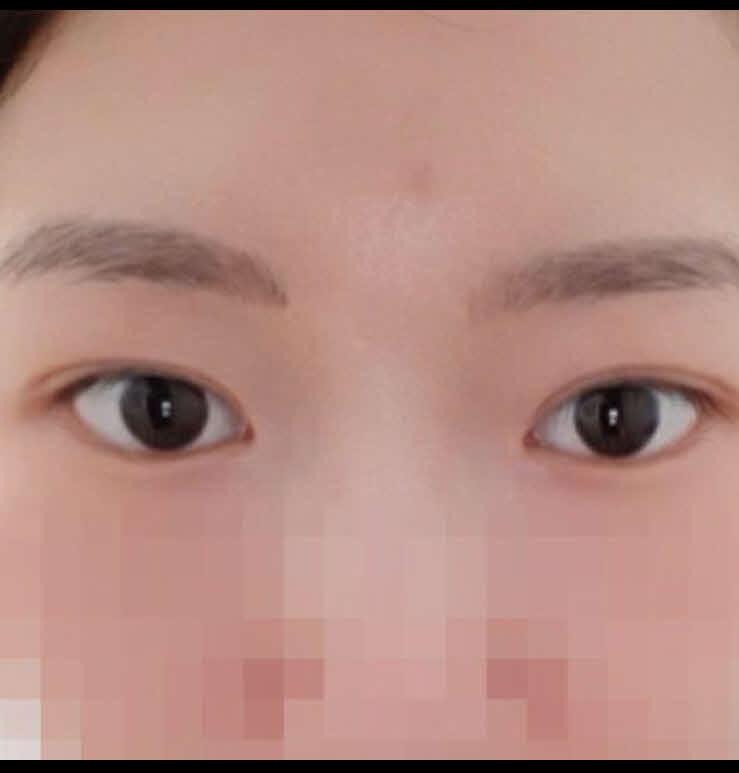 자연유착 4달차
