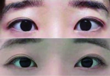 쌍커풀, 눈매교정 후기에용~