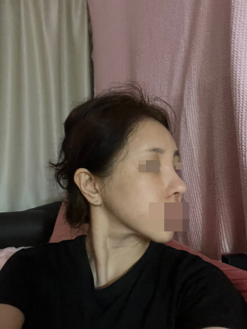 붓기 거의 다빠진거같은데 높이랑 모양 만족스러워요