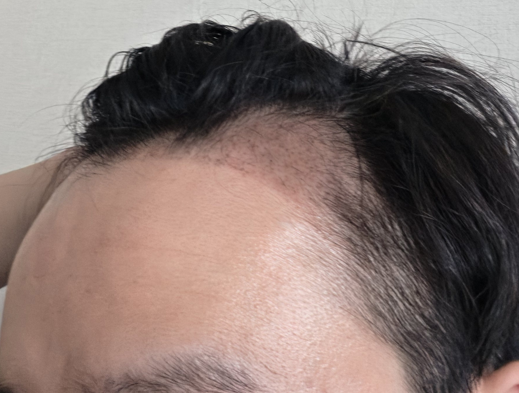 모발이식 비절개 삭발 1달차, 점점 자리잡는 이마라인
