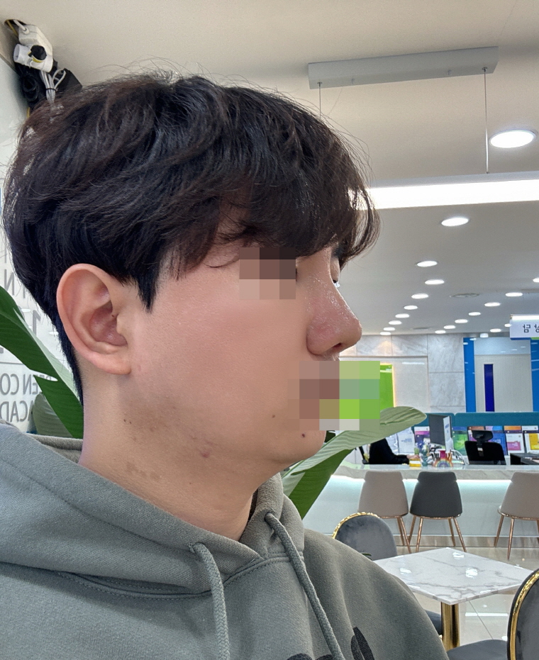 전체적으로 만족스러웠던 수술이었습니다.