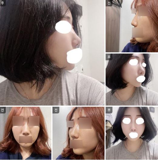 코 수술 3달차!