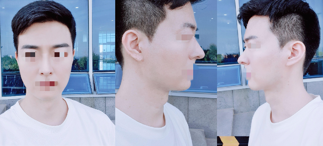 코 성형수술 두달차 후기입니다~