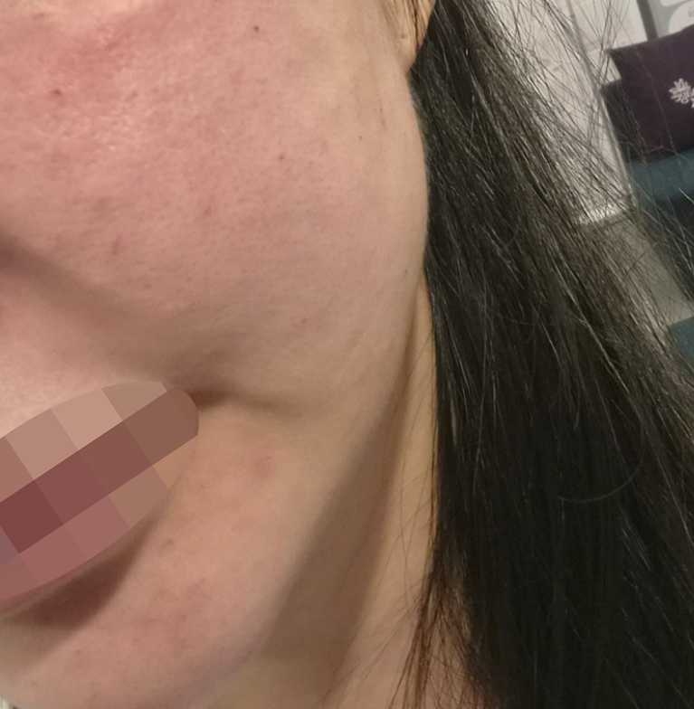 급하게 방문했는데 바로 시술 가능했어요~ 너무 만족이에요!