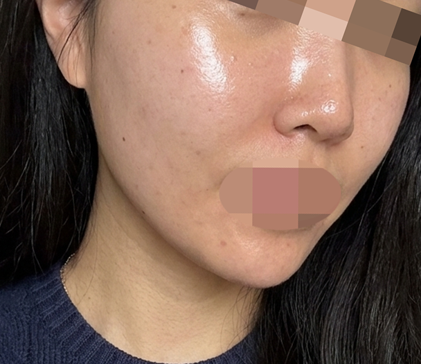 홈케어로는 한계인 피부 고민, 리쥬란으로 답을 찾았어요
