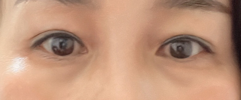 사나운 눈 마음에 안들어 수술했어요 시술 해주신 황원장님 너무 고맙습니다...