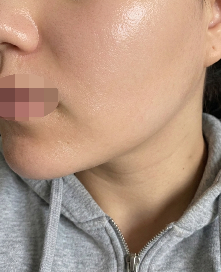 수면으로 통증 없이! 짧은 대기까지 만족스러운 엑소좀 후기예요!