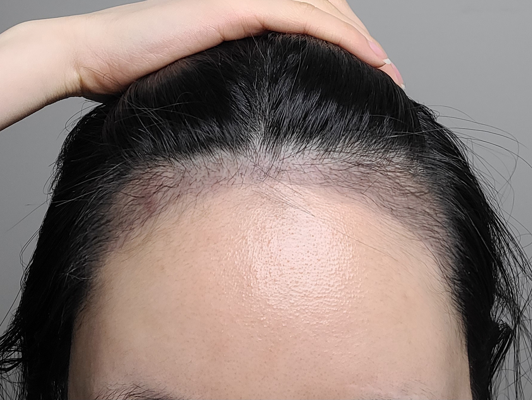 모발이식 절개 4000모 3개월차, 이제 변화가 눈에 보여요