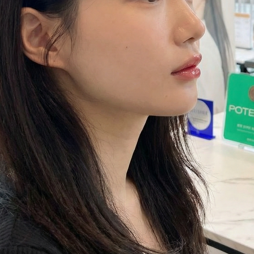 티타늄 풀페이스 받았는데 얼굴 전체적으로 탄력 올라왔어요