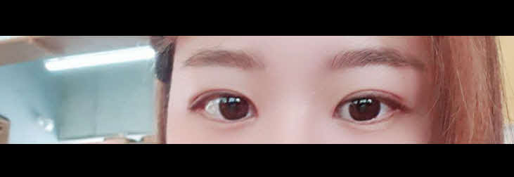 눈재수술~~