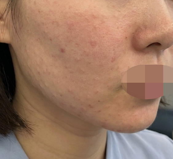 주변에서 피부 예쁘다고! 효과 확실해서 또 받으러 왔어요~~