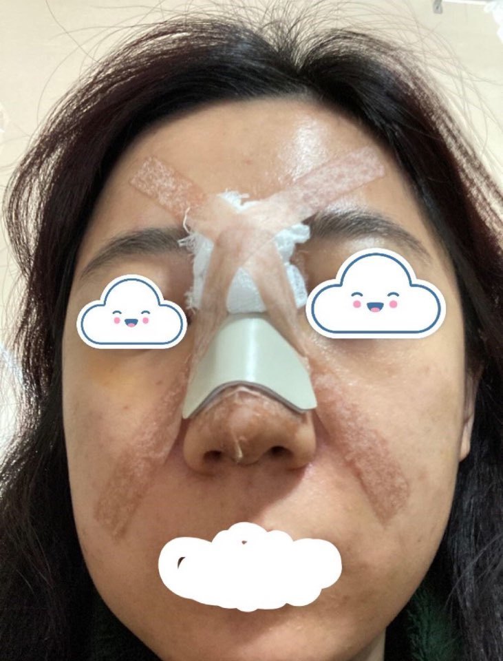 코수술후기입니다