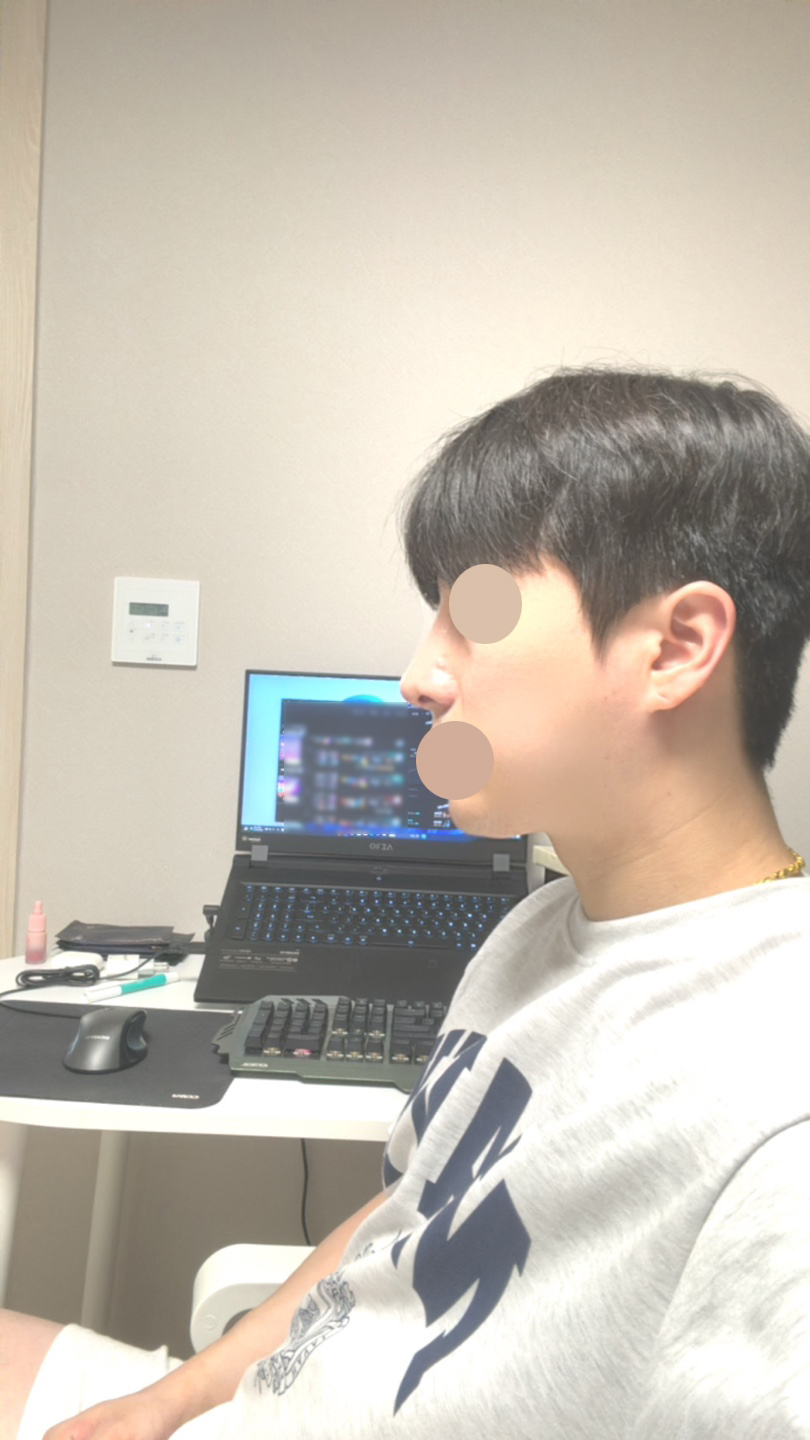 적당하게 코가 얄쌍해지고 콧볼도 줄어서 좋아요!