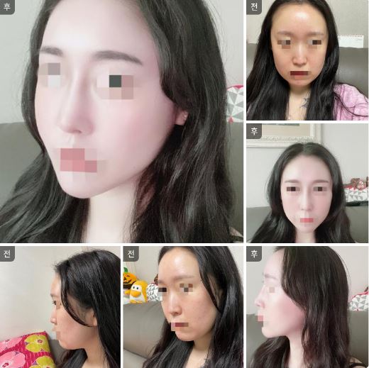 낮은코 고민 해결!