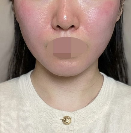얼굴 라인이 무너지는 것 같아서 인모드 받아봤어요!