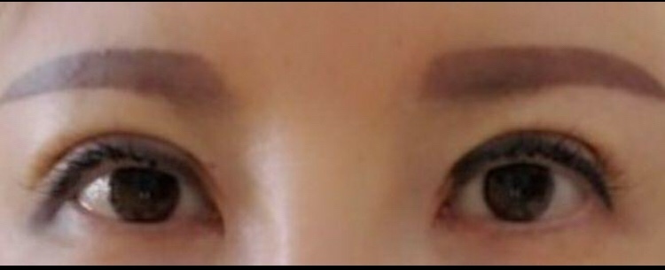 눈매교정 후기