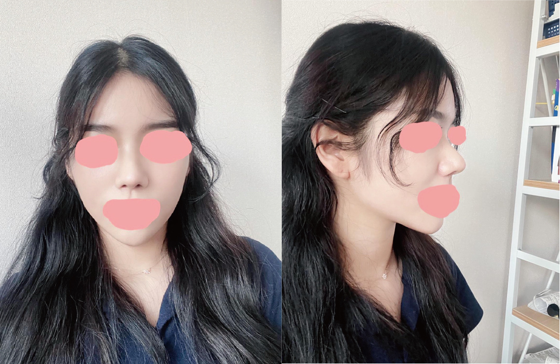 복코,콧볼축소,코끝 3개월차 후기에요