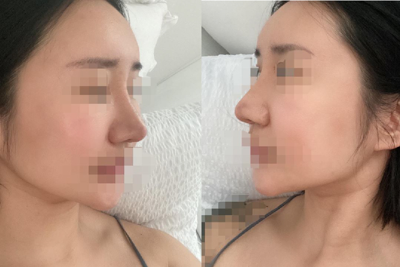 코 재수술하고 요즘 너무 행복한 나날을 보내고 있습니다!
