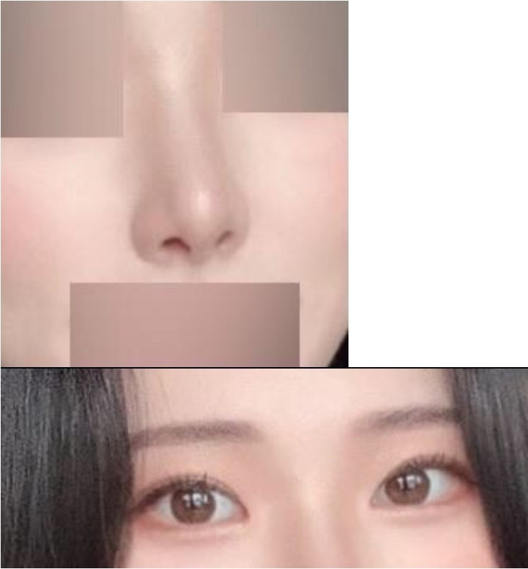 눈매교정 앞트임 복코 눈 재수술 2주차때입니다~