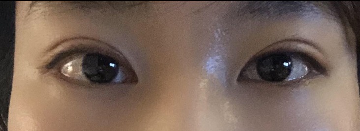 쌍꺼풀