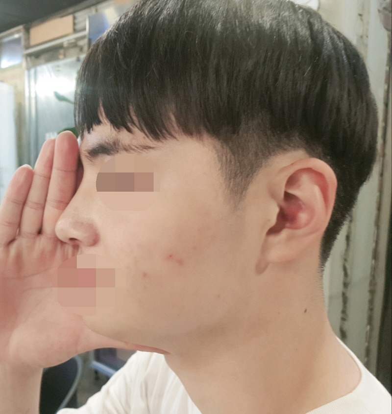 코(휜코,매부리,코끝 긴코 교정,콧대) 수술한지 20일차 후기 입니다.