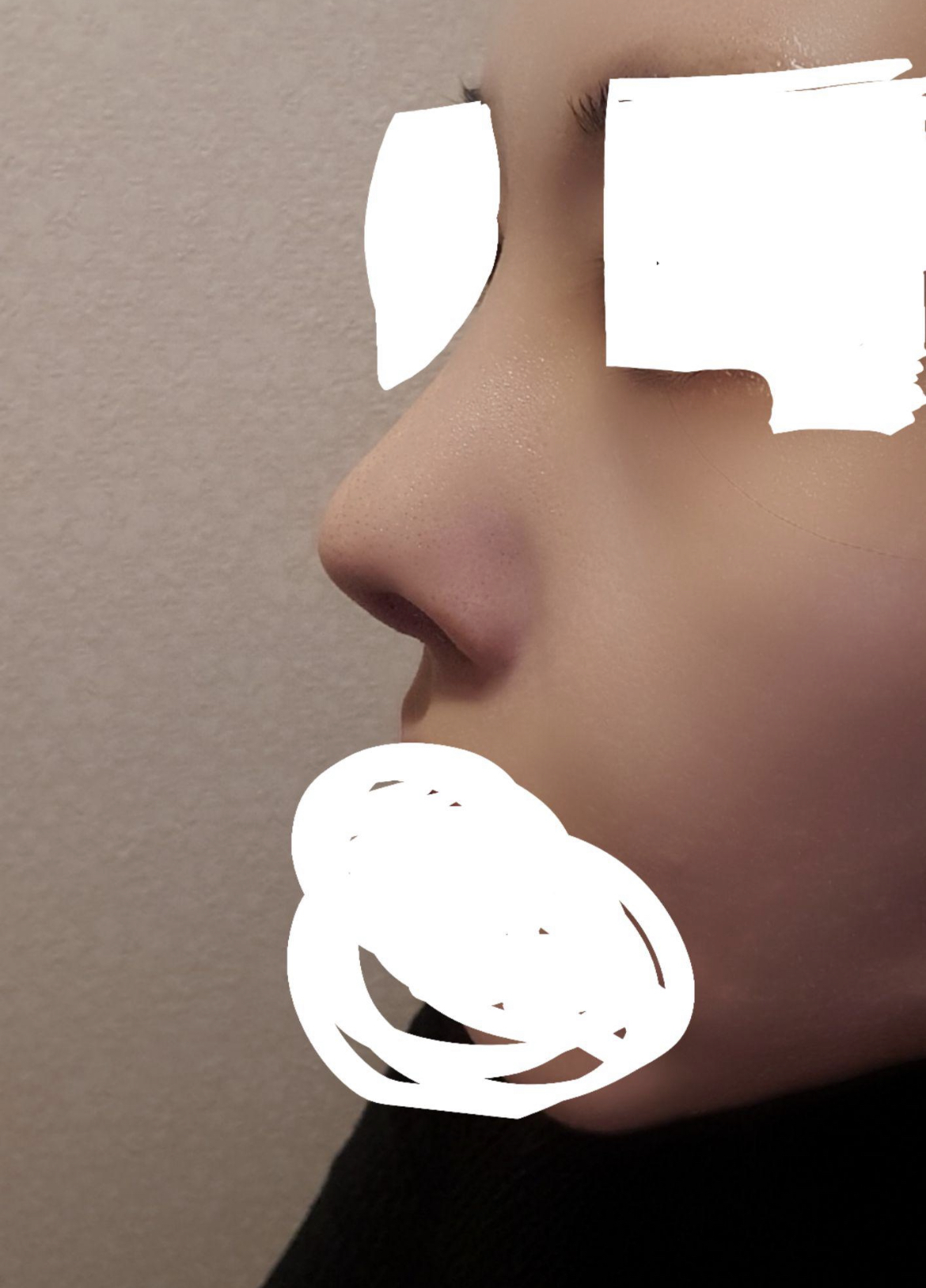 4번째 코재수술 진짜 솔찍후기