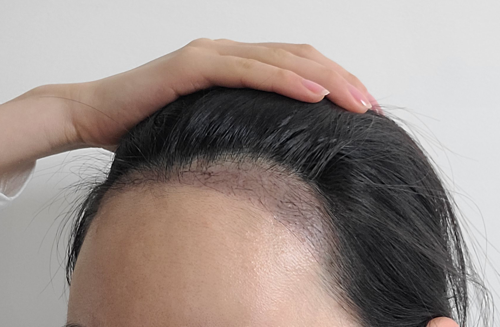 비절개 모발이식 2개월차, 관리까지 만족한 후기