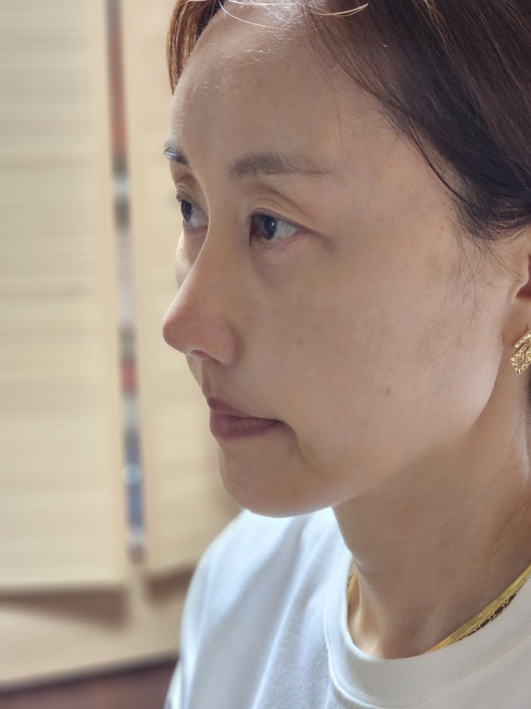 이마 지방이식, 코 재수술, 얼굴라인 실 리프팅 했어요