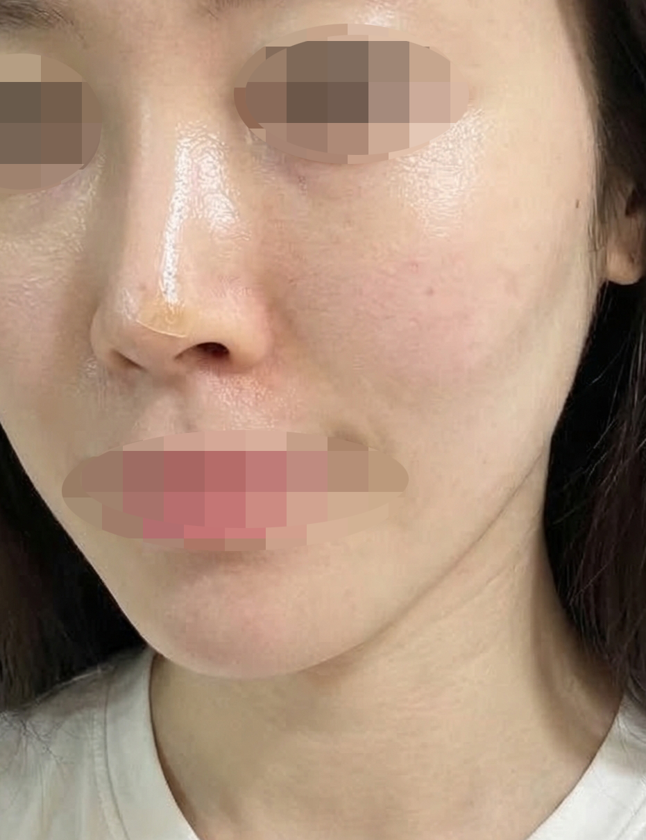 홍조 때문에 엑소좀 받았는데 하루 지나니까 좋아진 것 같아요 ㅎㅎ