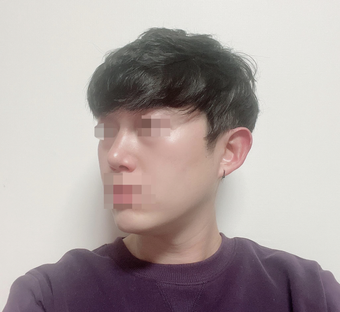 수술 후 사람다운 코가 됐습니다!