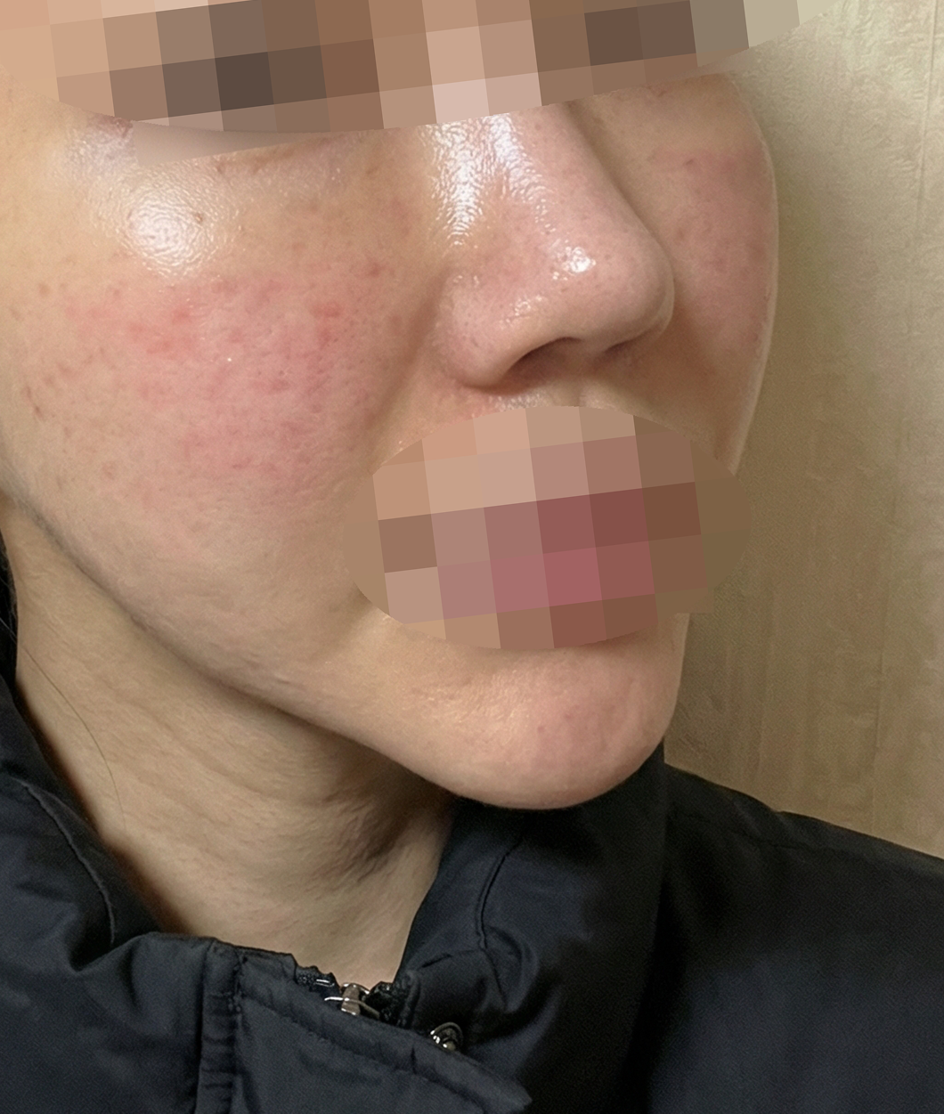 다운타임 짧고, 시술도 만족스러워요~ㅎㅎ