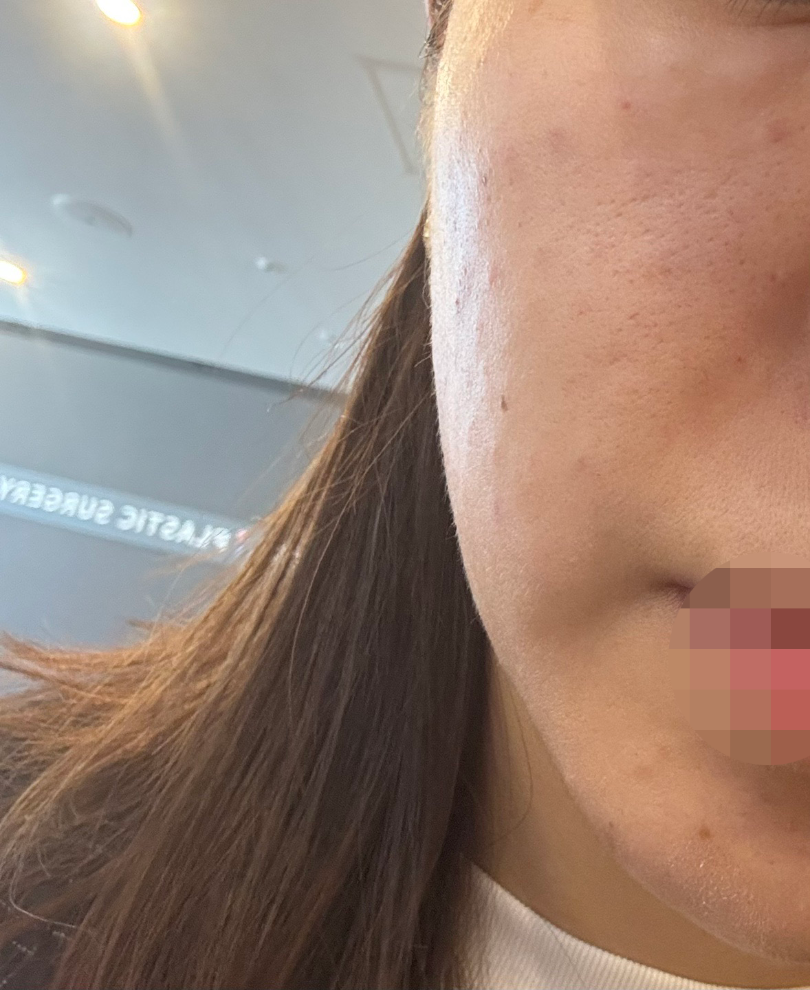 팔자주름 고민으로 리쥬써마, 믿고 또 찾아왔어요ㅎㅎ