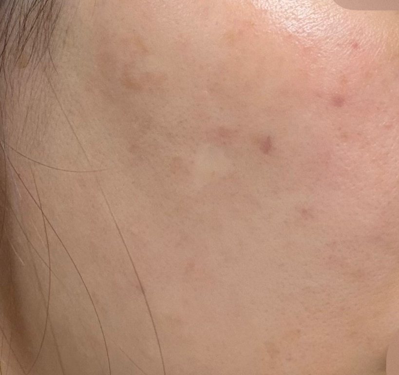 수면으로 통증 없이! 악명 높은 리쥬란도 부담 없이 받았어요