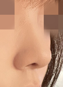 코 성형 한지 세달차입니다!