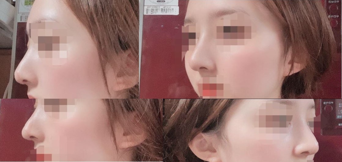 코수술 두달차후기