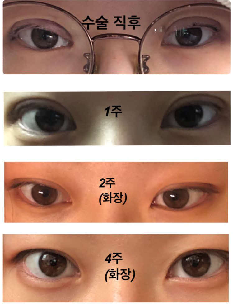 눈매교정 쌍수했어용
