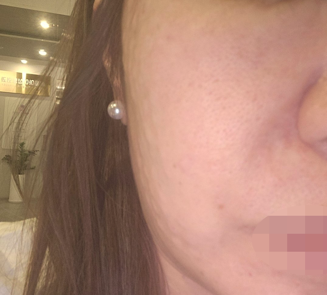 모공이랑 탄력 때문에 고민하다 리쥬란 드디어 도전했어요!