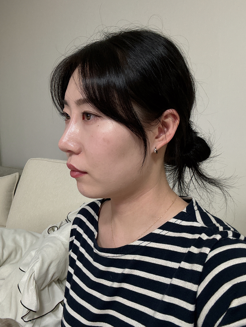 평소에 고민이었던 메부리도 없어지고 둥근 코 모양도 개선이 되어서 만족스럽습니다!